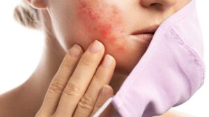 Person with red irritated skin on cheek – gut imbalance contributing to skin problems