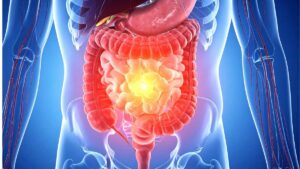 Inflamed digestive tract linked to sleep deprivation and stress.
